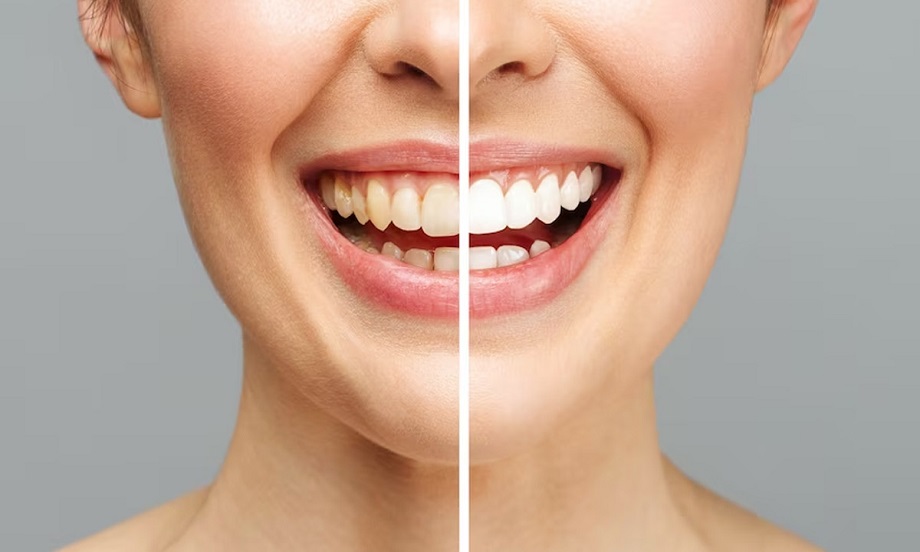 نمک صورتی برای دندان مفید است؟ + نحوه استفاده و 6 فایده